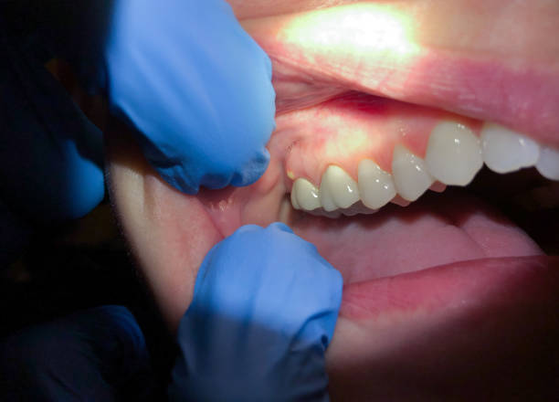 Best Chipped Tooth Repair Near Me  in South Padre Island, TX